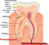 Периодонтит