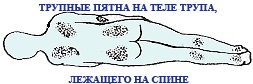 трупные пятна