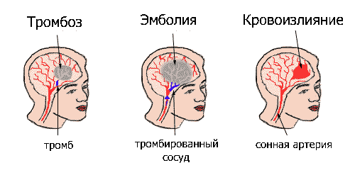 Заболевания сердечно-сосудистой системы