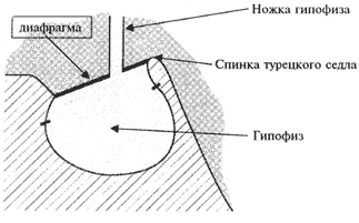 «Пустое» турецкое седло: этиология, патогенез, нейроэндокринные и зрительные нарушения