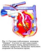 Коронарное шунтирование