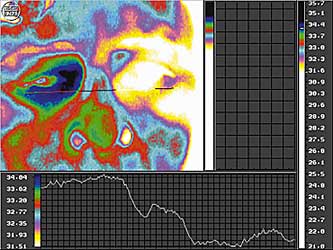 Компьютерная термография в диагностике злокачественных опухолей глаза и орбиты