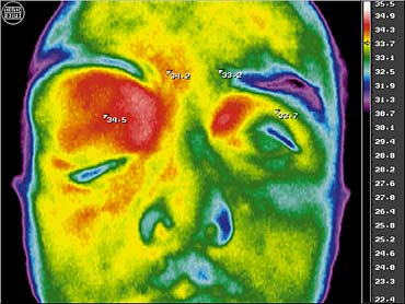 Компьютерная термография в диагностике злокачественных опухолей глаза и орбиты
